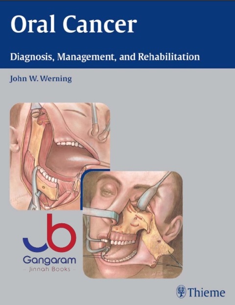 Oral Cancer Diagnosis Management and Rehabilitation 1st Edition