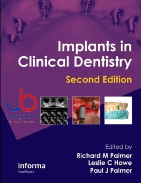 Implants in Clinical Dentistry 2nd Edition