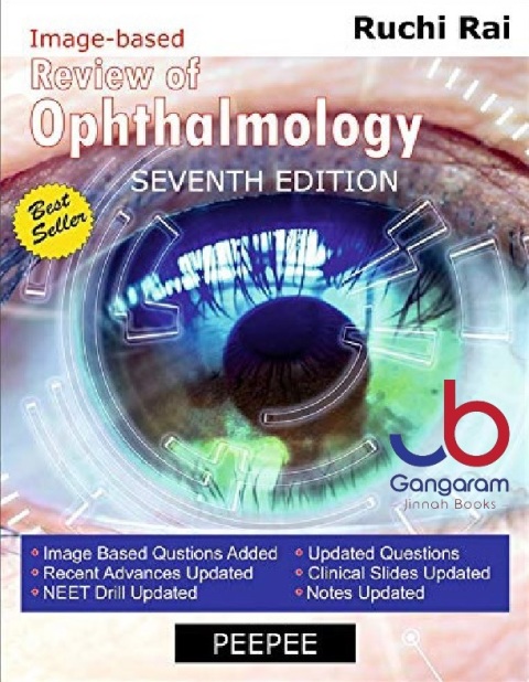 Review of Ophthalmology seventh edition.