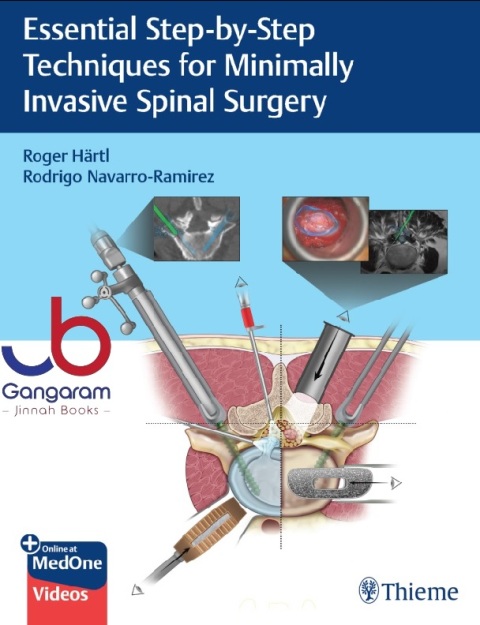 Essential Step-by-Step Techniques for Minimally Invasive Spinal Surgery 1st Edition