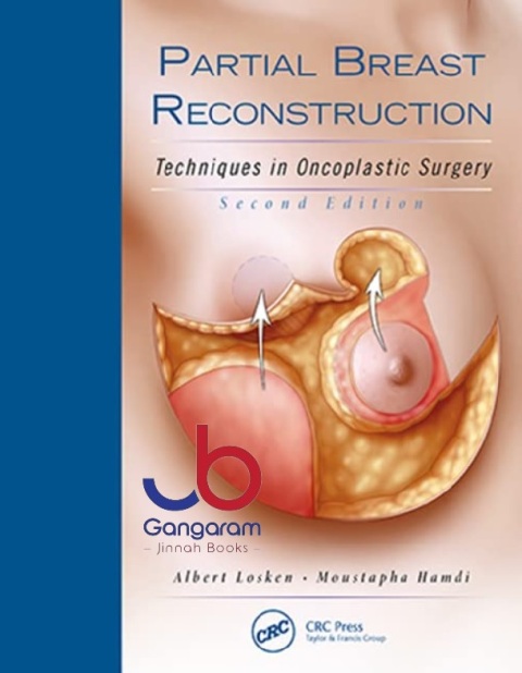 Partial Breast Reconstruction Techniques in Oncoplastic Surgery 2nd Edition