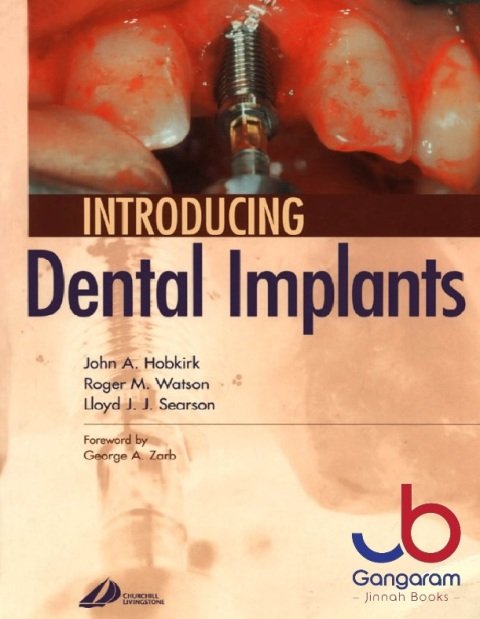 Introducing Dental Implants