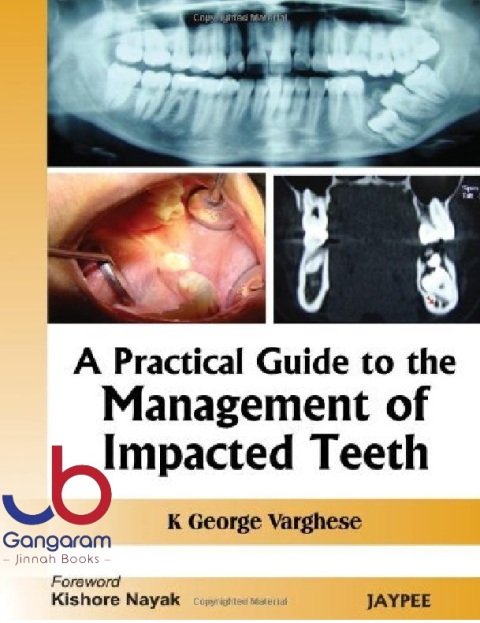 A Practical Guide to the Management of Impacted Teeth