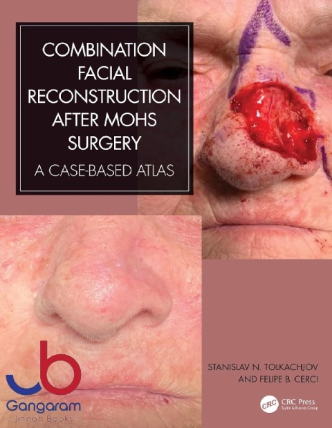 Combination Facial Reconstruction after Mohs Surgery A Case Based Atlas 1st Edition