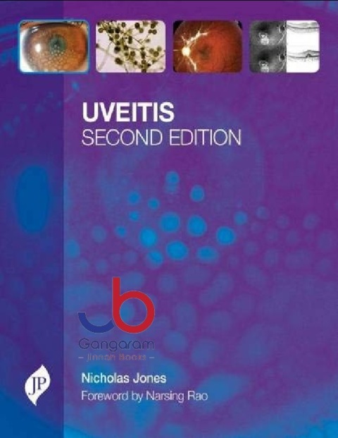 Uveitis Second Edition