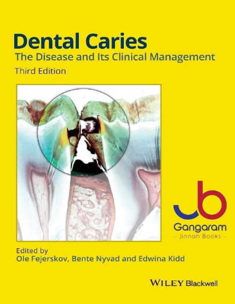 Dental Caries The Disease and its Clinical Management