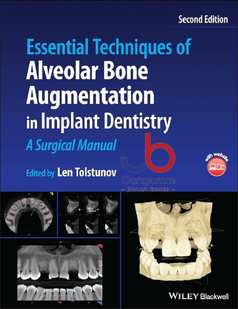 Essential Techniques of Alveolar Bone Augmentation in Implant Dentistry A Surgical Manual