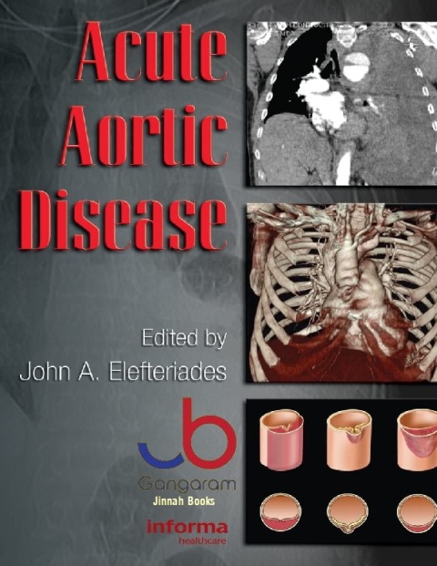 Acute Aortic Disease (Fundamental and Clinical Cardiology